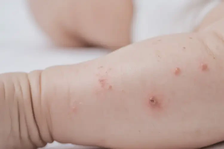 小兒小腿上偶爾起濕疹可不可以徹底自愈(圖4)