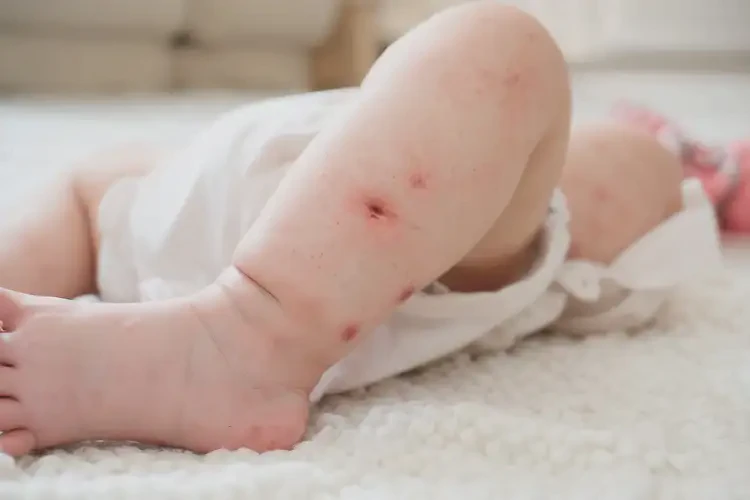 寶寶大腿偶爾起濕疹不管它會(huì)自己自愈嗎(圖4)
