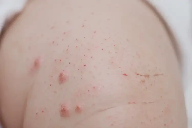 嬰兒大腿上長(zhǎng)濕疹能夠徹底治愈嗎(圖4)