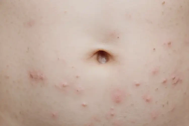 少兒肚子有濕疹不管它會自己自愈嗎(圖4)