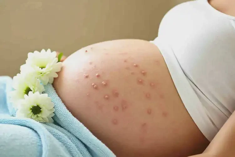 孕婦全身容易長濕疹可以徹底自愈嗎(圖3)