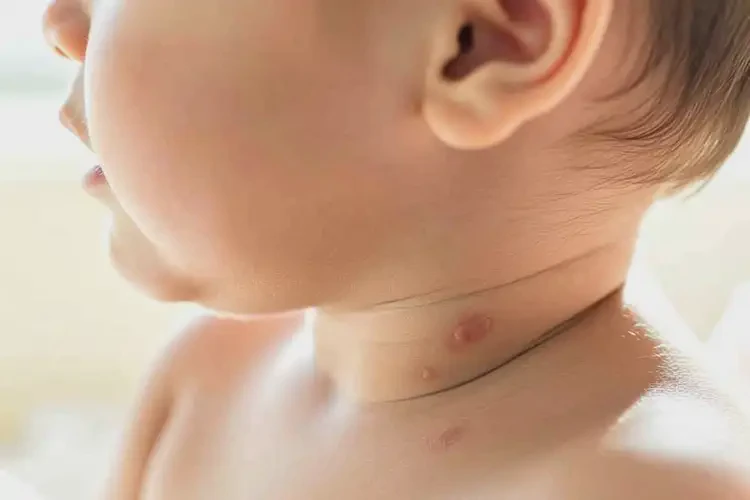 寶寶脖子上有濕疹能徹底自愈嗎(圖4)