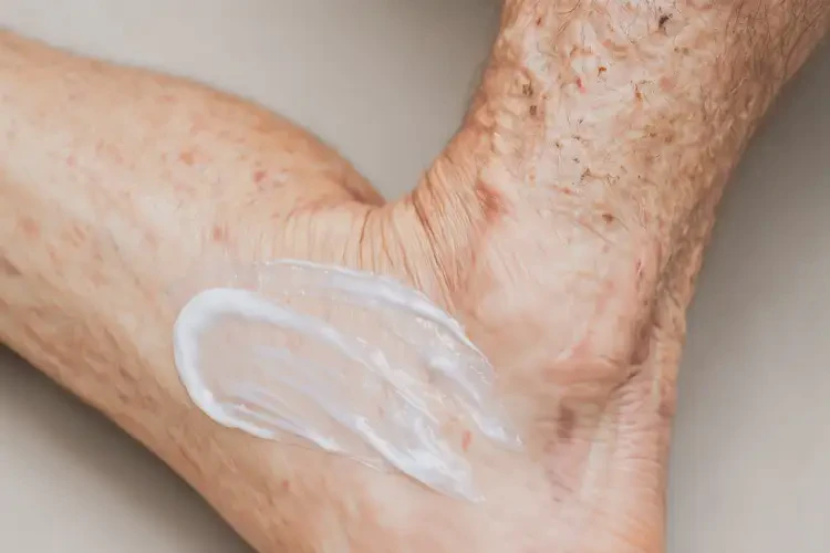 高齡老人小腿容易長濕疹不管它會自己好嗎(圖3)