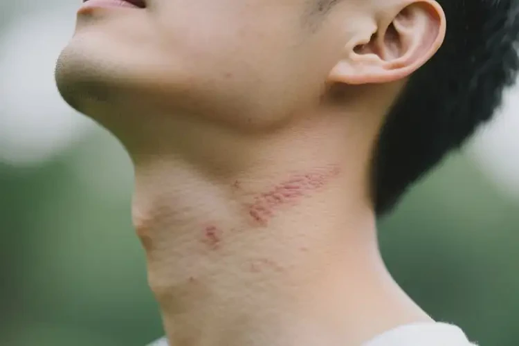 男人脖子經(jīng)常長濕疹能徹底自愈嗎(圖2)