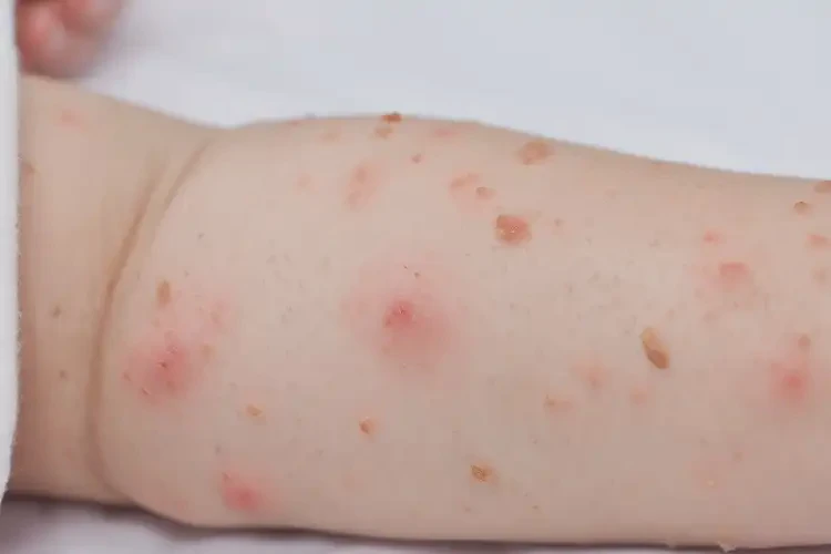 幼兒手臂容易起濕疹可不可以徹底自愈(圖4)