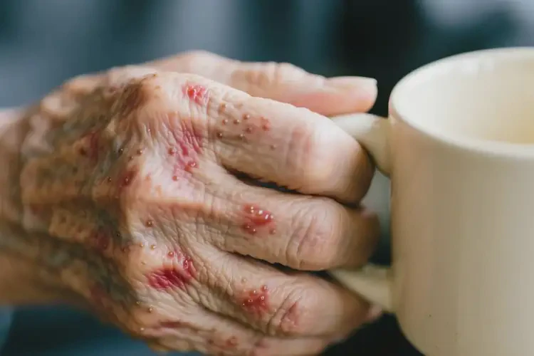 老人手上經(jīng)常起濕疹不管它會(huì)自己痊愈嗎(圖1)