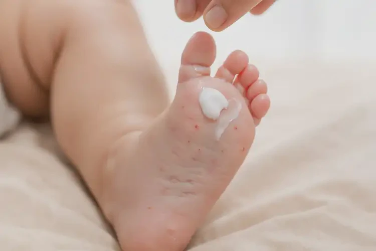 新生兒腳上長濕疹可以徹底自愈嗎(圖3)