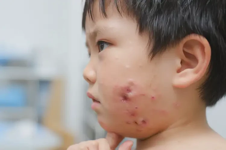 兒童脖子上容易長濕疹可不可以徹底自愈(圖4)