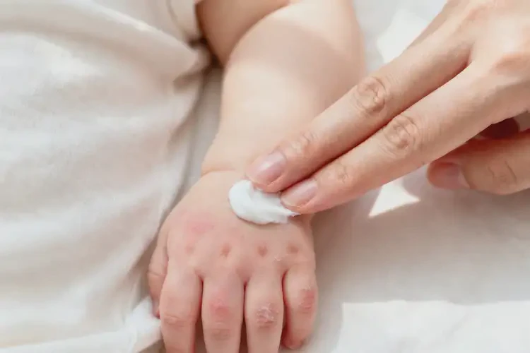嬰兒手上出濕疹能靠自己自愈嗎(圖1)