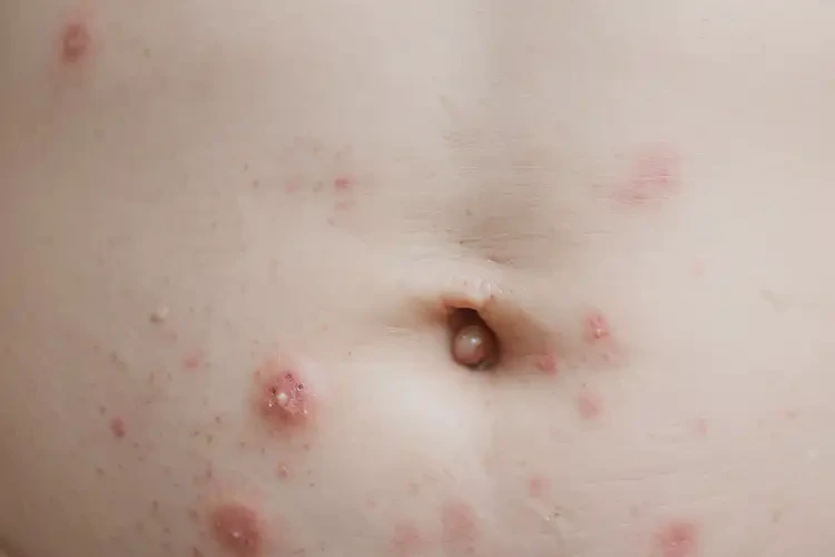 婴儿肚子上有湿疹能够彻底治愈吗(图4)