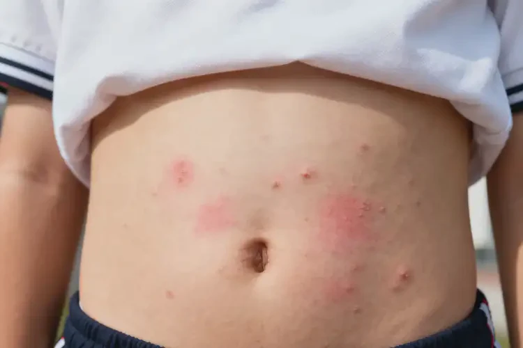中學(xué)生肚子上出現(xiàn)濕疹可以徹底自愈嗎(圖3)
