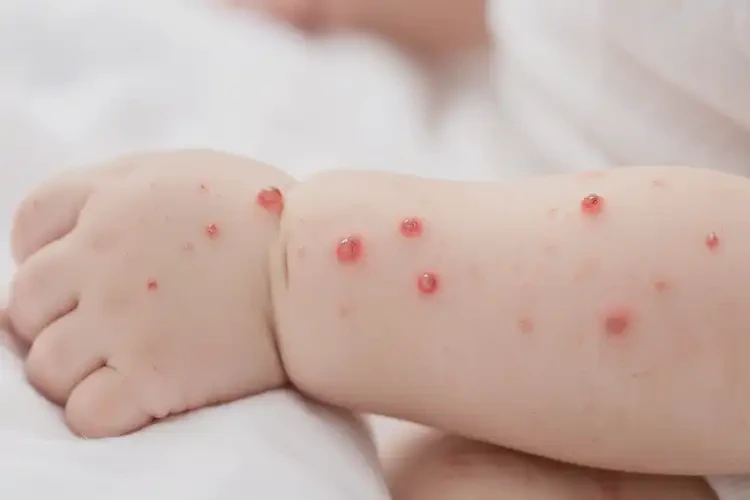 寶寶手臂起濕疹不管它會自己好嗎(圖3)