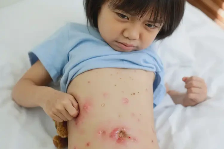 孩子肚子上容易長濕疹能靠自己自愈嗎(圖3)