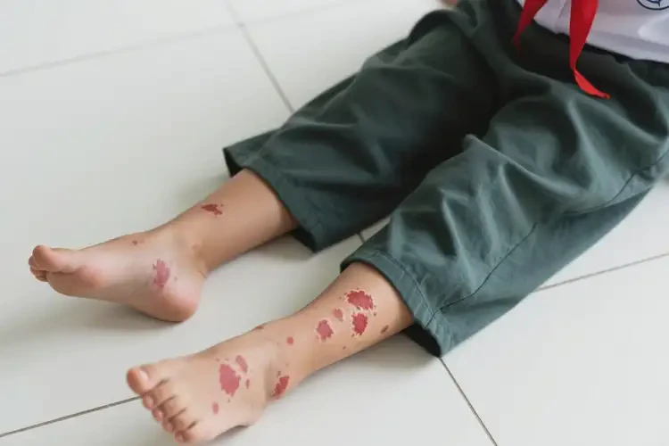 小學(xué)生四肢長(zhǎng)濕疹不管它會(huì)自己自愈嗎(圖2)