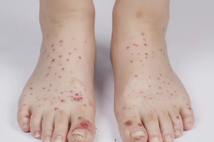 小學生腳上容易長濕疹不管它會自己痊愈嗎(圖4)