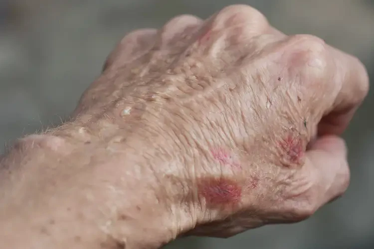 老年人手上容易起湿疹能够彻底治愈吗(图4)