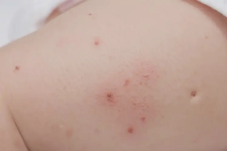 寶寶大腿上容易起濕疹能徹底自愈嗎(圖4)