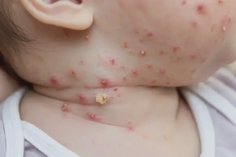 寶寶脖子上長濕疹可以徹底自愈嗎(圖4)