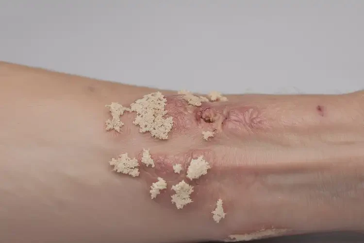 青少年四肢容易起濕疹不管它會(huì)自己好嗎(圖2)