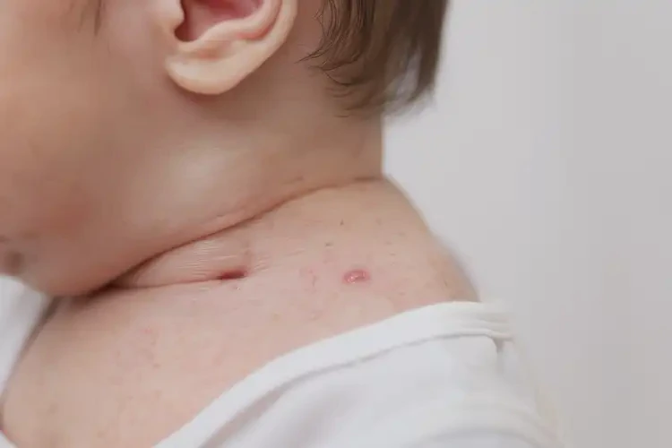 新生兒脖子偶爾長濕疹不管它會自己自愈嗎(圖4)