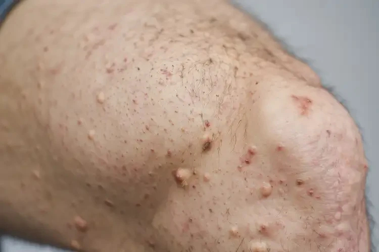 男性大腿出現(xiàn)濕疹不管它會自己痊愈嗎(圖4)