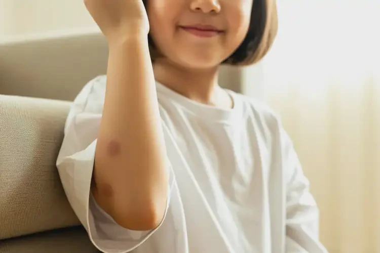 孩子手臂上容易起濕疹可以徹底自愈嗎(圖1)