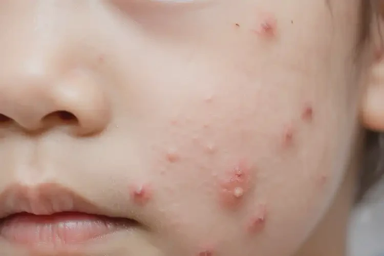 兒童面部有濕疹不管它會自己痊愈嗎(圖4)