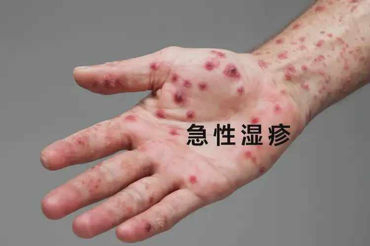 男人手上長濕疹不管它會自己好嗎(圖4)