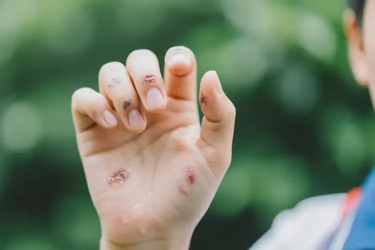 中學生手上長濕疹不管它會自己痊愈嗎(圖2)