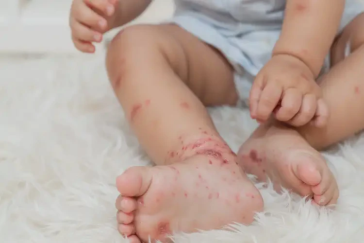 幼兒小腿上容易長濕疹不管它會自己自愈嗎(圖4)