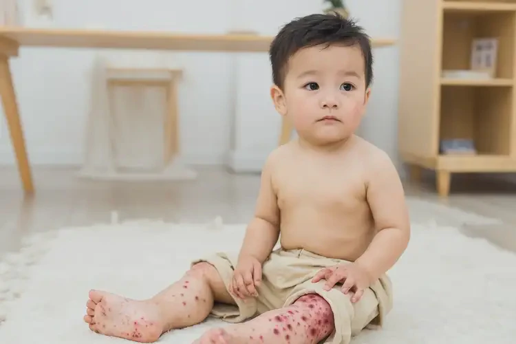 幼兒大腿上容易長濕疹能徹底自愈嗎(圖3)