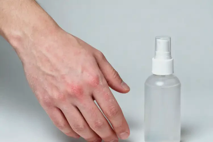 青年人手上經(jīng)常長濕疹能不能徹底自愈(圖1)