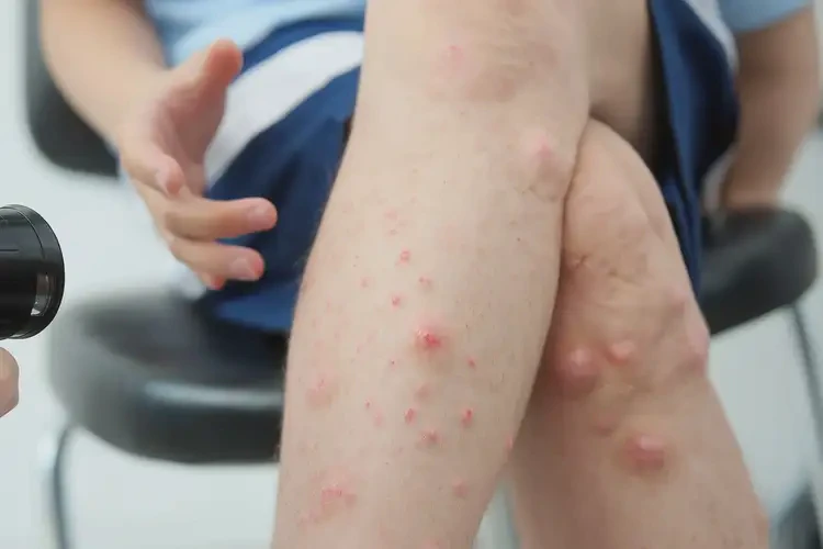 中學(xué)生腳上出濕疹可不可以徹底自愈(圖4)
