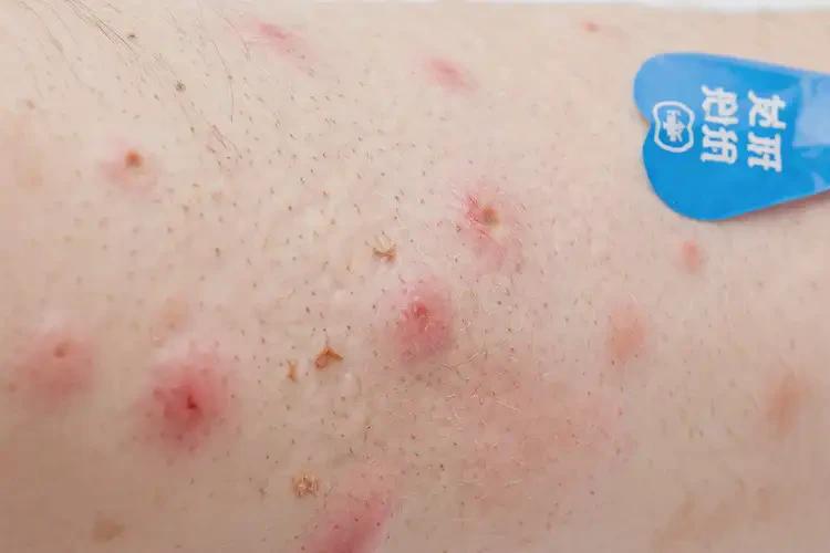 男生臉上容易長濕疹不管它會(huì)自己痊愈嗎(圖4)