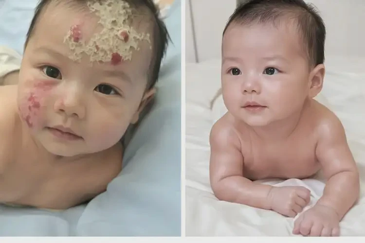 寶寶肛周容易起濕疹可不可以徹底自愈(圖1)