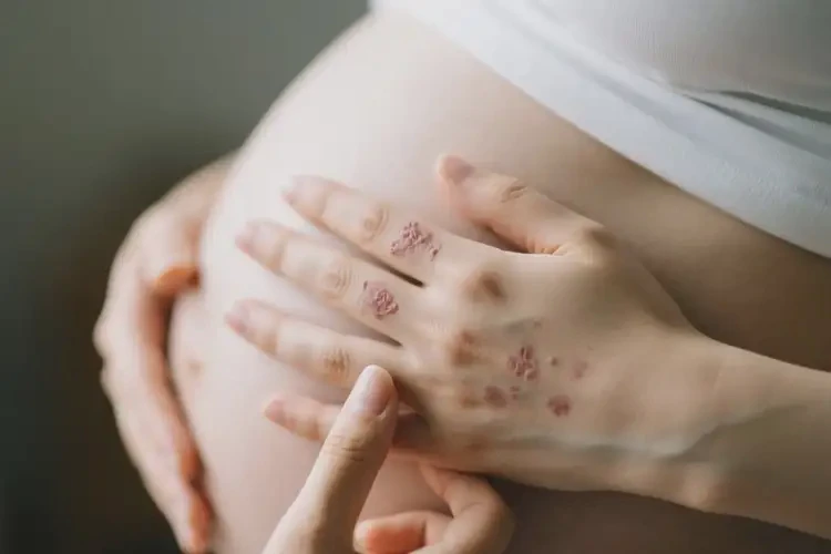 產(chǎn)婦全身出現(xiàn)濕疹不管它會(huì)自己自愈嗎(圖3)