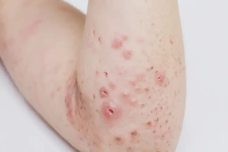 小兒身上偶爾起濕疹不管它會自己自愈嗎(圖3)