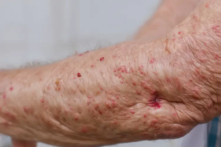 高龄老人手臂上出湿疹不管它会自己痊愈吗(图4)