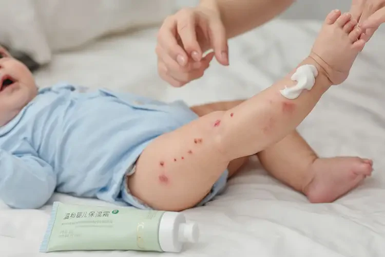 嬰兒小腿上偶爾長(zhǎng)濕疹能靠自己自愈嗎(圖3)