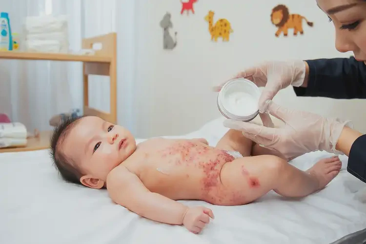 嬰幼兒大腿經(jīng)常起濕疹能夠徹底治愈嗎(圖3)