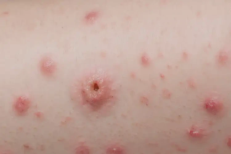 小孩小腿上出濕疹不管它會(huì)自己自愈嗎(圖4)