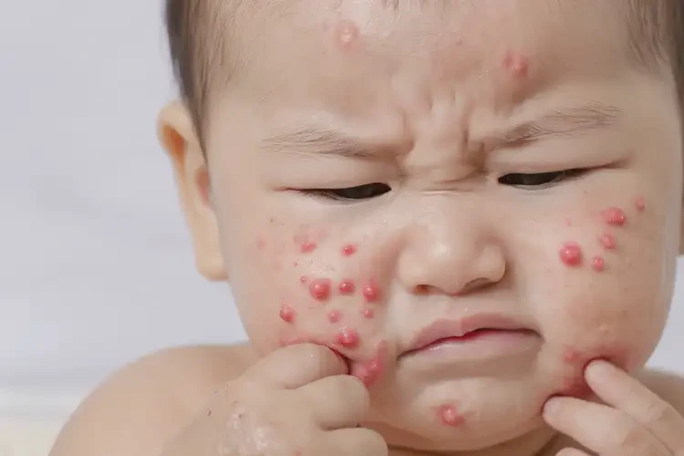 寶寶面部容易起濕疹能夠徹底治愈嗎(圖4)