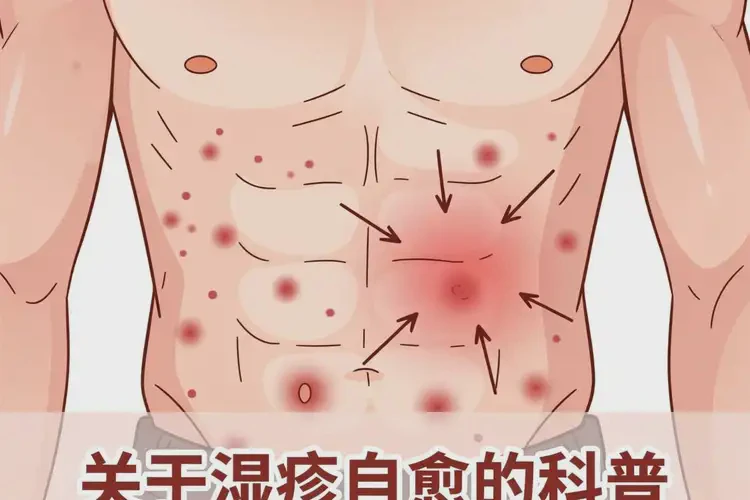男人肚子起濕疹可以徹底自愈嗎(圖1)