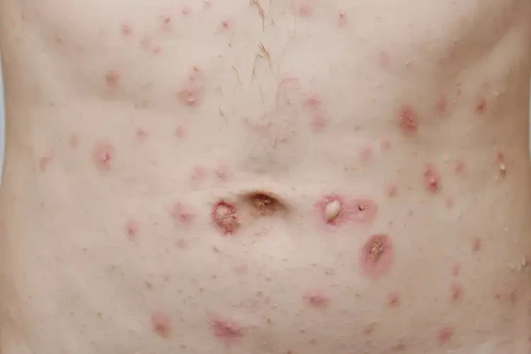 青少年肚子長(zhǎng)濕疹能徹底自愈嗎(圖4)