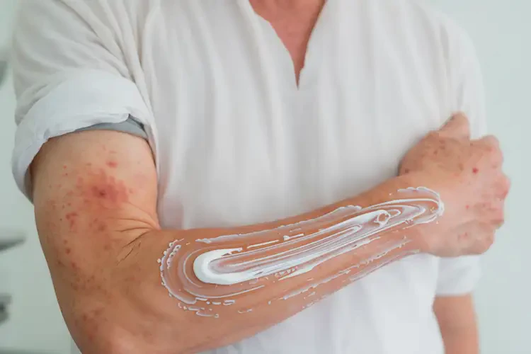 男人手臂上起濕疹能徹底自愈嗎(圖2)