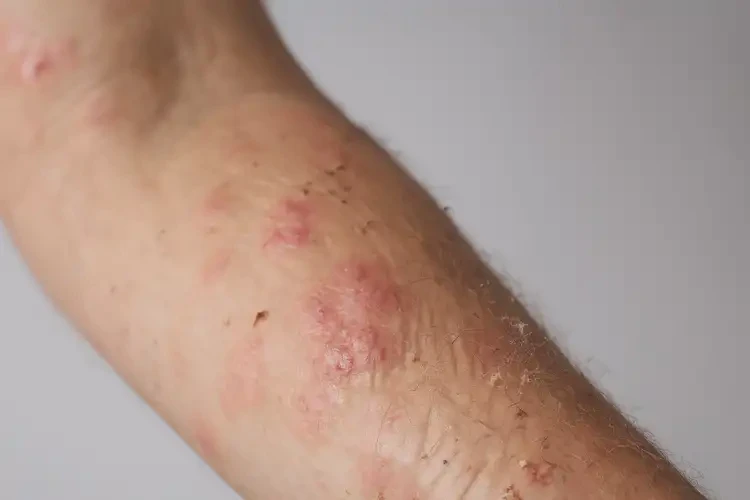 女性屁股上容易长湿疹可以彻底自愈吗(图4)