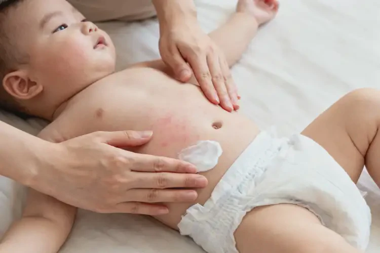 小兒肚子容易起濕疹不管它會(huì)自己好嗎(圖2)