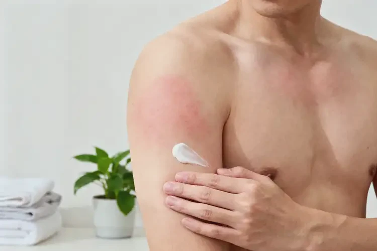 男人全身偶爾起濕疹能夠徹底治愈嗎(圖1)