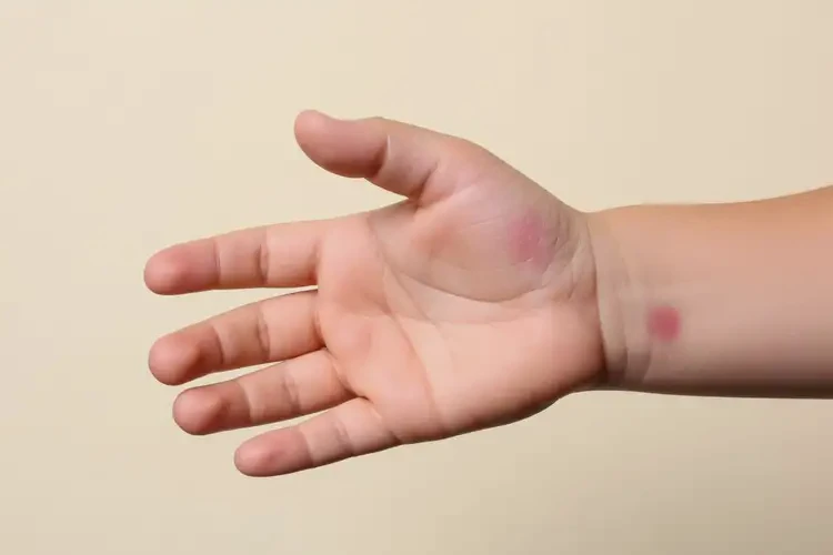 小孩手臂偶爾起濕疹不管它會自己好嗎(圖4)