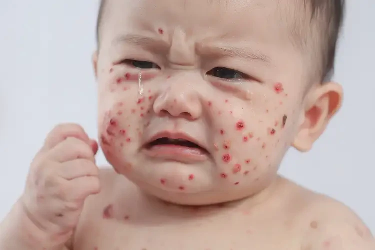 寶寶身上容易起濕疹能靠自己自愈嗎(圖4)